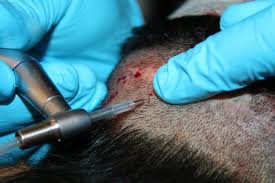 Neograft Donor Sit7e Harvest Dr Barry Eppley Indianapolis