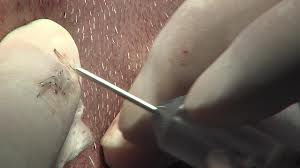 Neograft Powered Hair Insertion Dr Barry Eppley Indianapolis