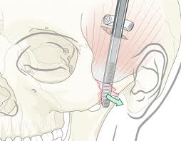 Zygomatic Arch Fracture Repair Dr Barry Eppley Indianapolis