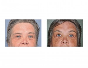 Endoscopic Browlift with Blepharoplasties result front view Dr Barry Eppley Indianapolis