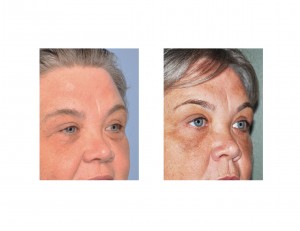 Endoscopic Browlift with Blepharoplasties result oblique view Dr Barry Eppley Indianapolis