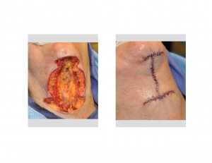 Female Direct Neck Wattle Excision Dr Barry Eppley Indianapolis