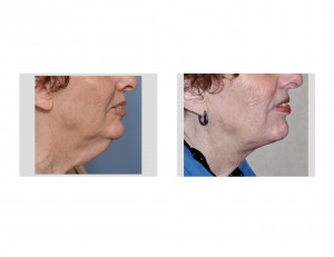 Female Direct Necklift result side view Dr Barry Eppley Indianapolis