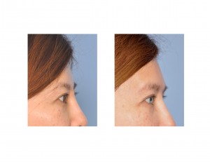 Female Forehead Augmentation result side view Dr Barry Eppley Indianapolis