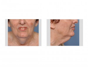 Female Neck Wattle before surgery Dr Barry Eppley Indianapolis.