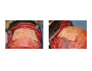 Hydroxyapatite Forehead Augmentation intraop Dr Barry Eppley Indianapolis