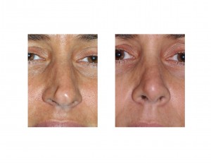 Long Nose Rhinoplasty result frnt view Dr Barry Eppley Indianapolis