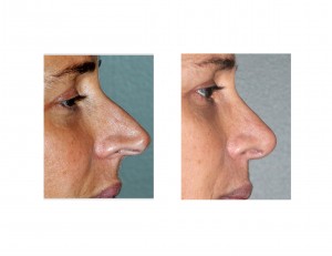Long Nose Rhinoplasty result side view Dr Barry Eppley Indianapolis