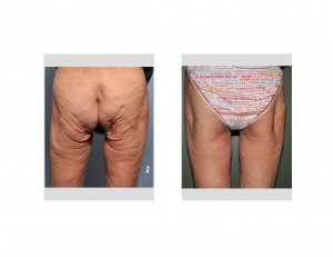 Lower Buttock Lift result back view Dr Barry Eppley Indianapolis