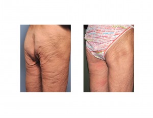 Lower Buttock Lift result right oblique Dr Barry Eppley Indianapolis view