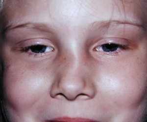 Nose Fracture in Child Dr Barry Eppley Indianapolis