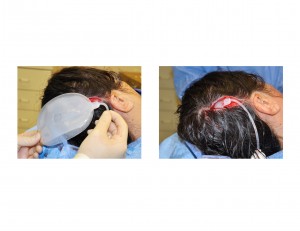 Scalp Tissue Expander Placement in Cranioplasty Dr Barry Eppley Indianapolis