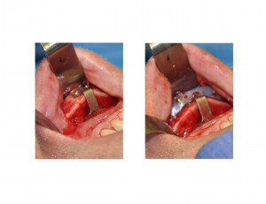 Slding Genioplasty with Implant Overlay Dr Barry Eppley Indianapolis