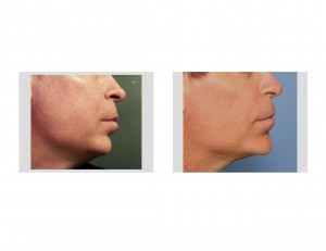 Sliding Genioplasty for Chin Implant Replacement Dr Barry Eppley Indianapolis