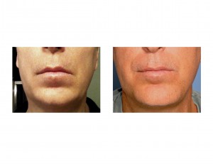 Sliding Genioplasty with Implant front view Dr Barry Eppley Indianapolis