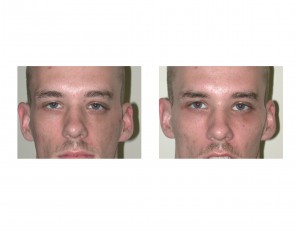 Traumatic Cheek Deformity Reconstruction front view Dr Barry Eppley Indianapolis