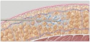 Tumescent Liposuction Dr Barry Eppley Indianapolis