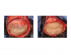 Two Layer Cranioplasty Dr Barry Eppley Indianapolis
