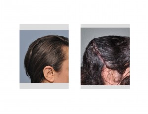 Two Stage Cranioplasty Dr Barry Eppley Indianapolis