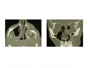 Zygomatic Fracture Dr Barry Eppley Indianapolis