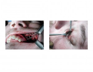 Zygomatic Osteotomy Reconstruction during surgery Dr Barry Eppley Indianapolis