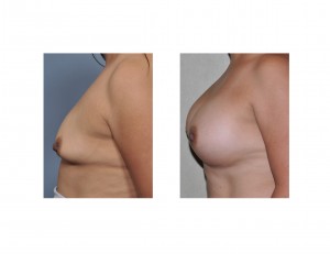 Bfreast Augmentation Lift result Dr Barry Eppley Indianapolis