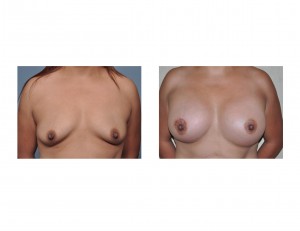 Breast Augmentation Lift result front view Dr Barry Eppley Indianapolis