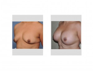 Breast Augmentation Lift result oblique view Dr Barry Eppley Indianapolis