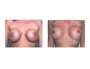 Breast Implant Revision results front view Dr Barry Eppley Indianapolis