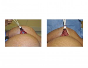 Buttock Implant Placement Dr Barry Eppley Indianapolis