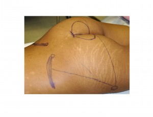 Buttock Implants surgery outline Dr Barry Eppley Indianapolis