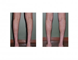 Clubfoot Calf Implants result back view