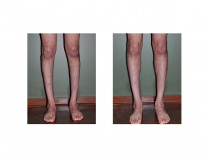Clubfoot Calf Implants resultfront view