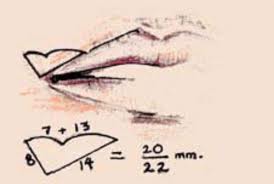 Corner of the Mouthu Lift diagram Dr Barry Eppley Indianapolis