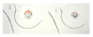 Crescent nipple lift Dr Barry Eppley Indianapolis