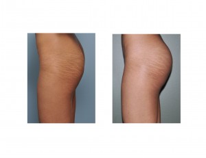 EW Buttock Implant Result left side view