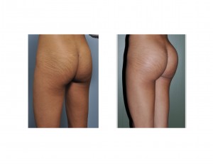 EW Buttock Implant result left oblique view