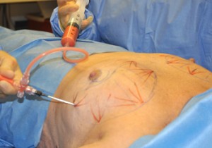 Fat Injection Breast Augmentation Indianapolis Dr Barry Eppley
