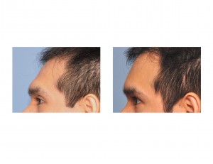 Forehead Augmentation for Prominent Brow Bones result Dr Barry Eppley Indianapolis