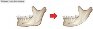 Jaw Angle Reduction Surgery Dr Barry Eppley Indianapolis