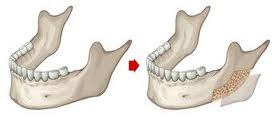 Jawl Angle Reduction Surgery Dr Barry Eppley Indianapolis