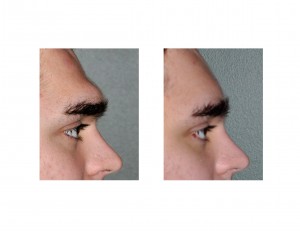 Large Brow Bone Reduction result Dr Barry Eppley Indianapolis