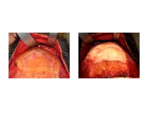 Male HA Forehead Augmentation intraop Dr Barry Eppley Indianapolis