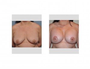 Nipple Lift with Breast Augmentation results front view Dr Barry Eppley Indianapolis