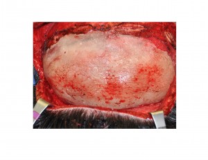 Occipital Cranioplasty during surgery Dr Barry Eppley Indianapolis