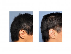 Occipital Cranioplasty result side view Dr Barry Eppley Indianapolis