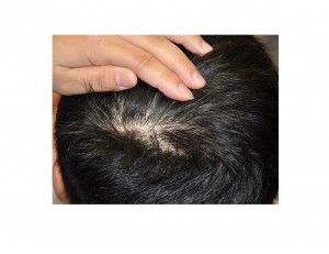 Occipital Cranioplasty scar Dr Barry Eppley Indianapolis