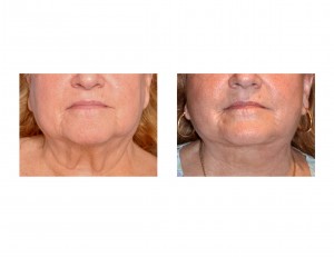 RH Facelift result front view closeup