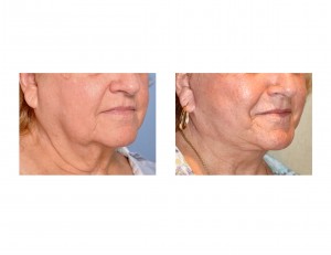 RH Facelift result oblique view closeup