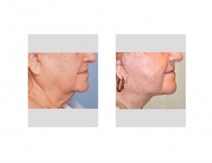 RH Facelift result side view closeup